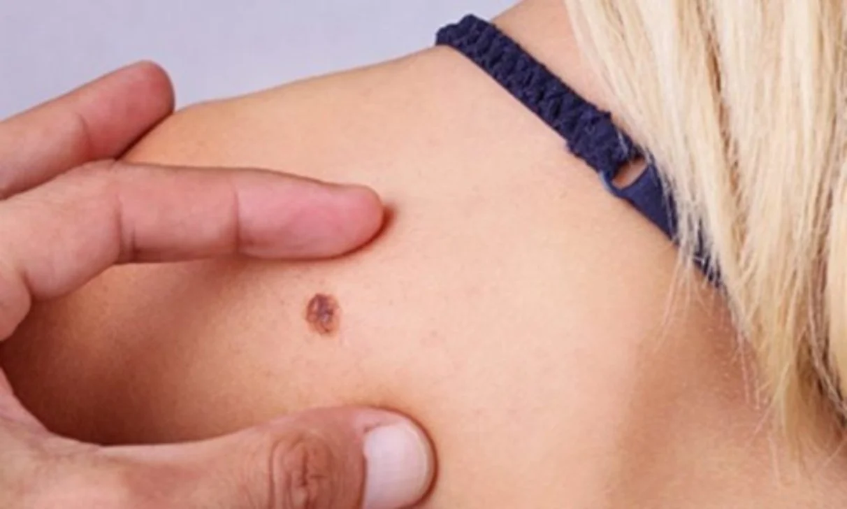 Vacina personalizada da Moderna avança na luta contra o melanoma